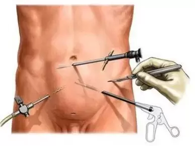 chirurginis lėtinio prostatito gydymas