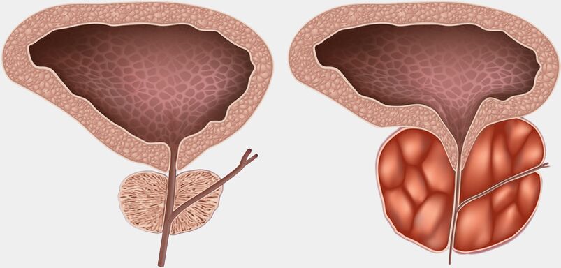 sveika ir uždegusi prostata su prostatitu