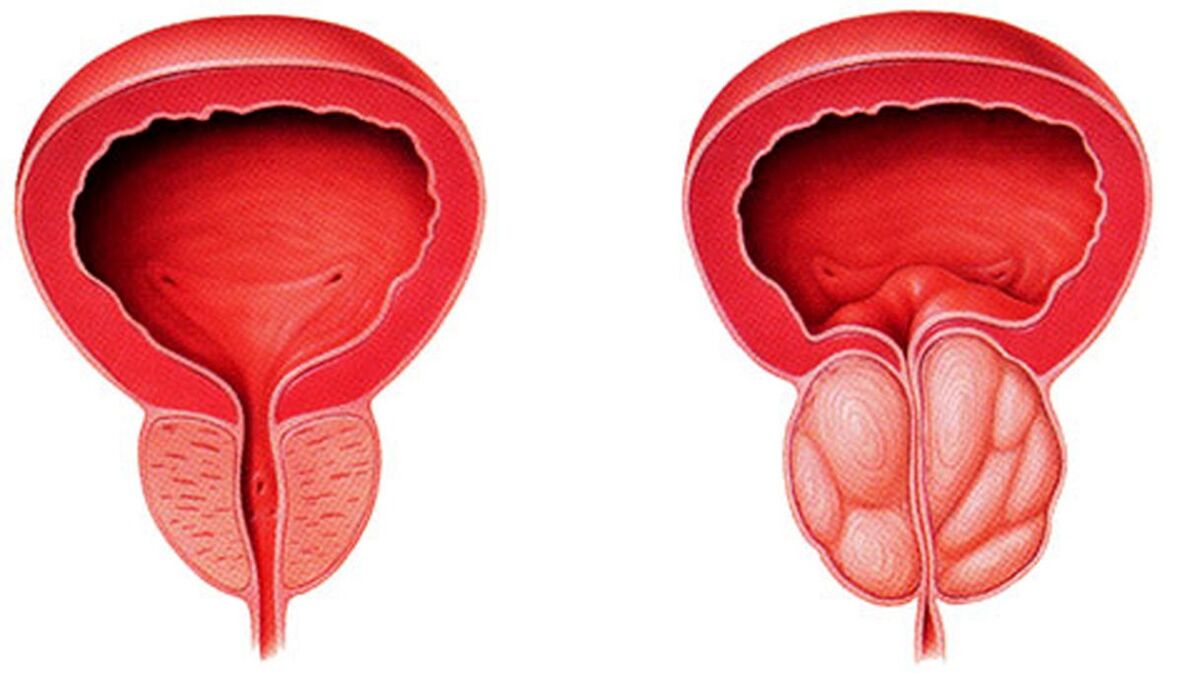 sveika ir uždegusi prostata su prostatitu