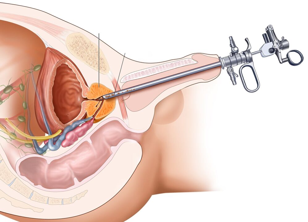 Transuretrinė prostatos rezekcija leidžia pašalinti pažeistas organo dalis