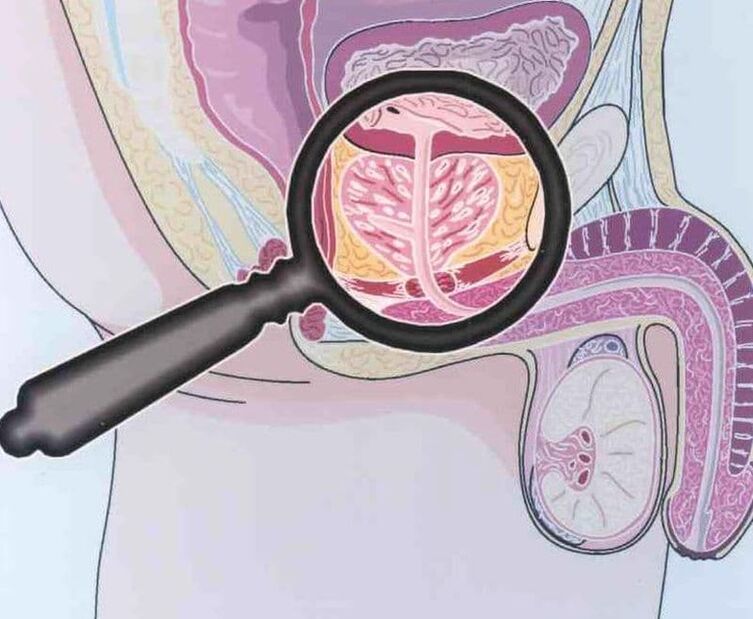 Prostatos audinio nugalėjimas pacientams, sergantiems lėtiniu prostatitu, vyrams