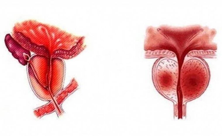 Ūminis prostatos uždegimas, kuris gali tapti lėtinis